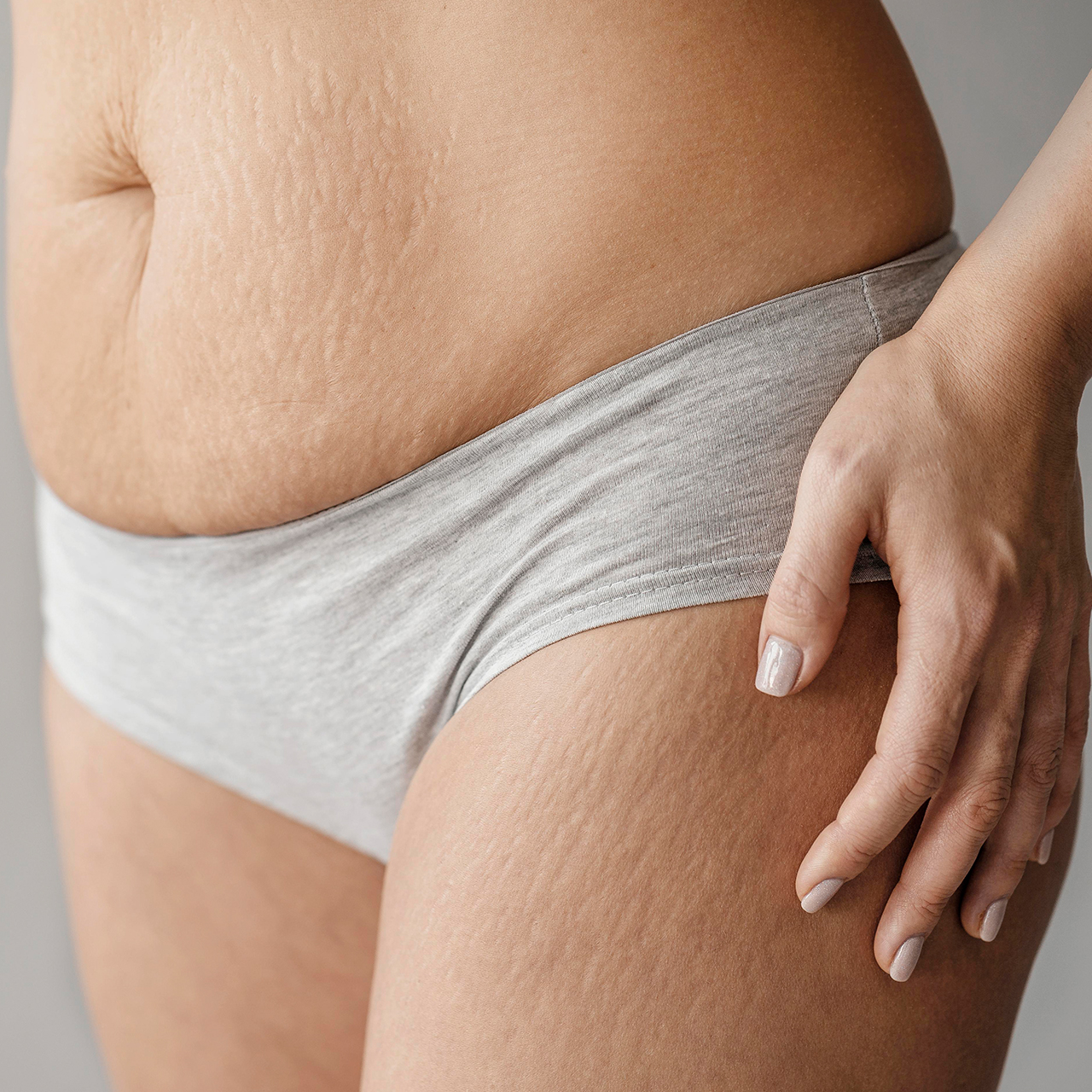 Cellulite and skin laxity